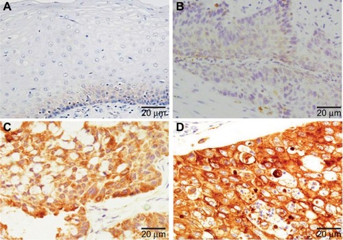 Figure 2 RRBP1 expression was detected in esophageal carcinoma and matched adjacent normal tissues by immunohistochemical staining.Notes: (A) Adjacent normal tissues; (B) weak staining of RRBP1 in esophageal carcinoma; (C) moderate staining of RRBP1 in esophageal carcinoma; (D) strong staining of RRBP1 in esophageal carcinoma.