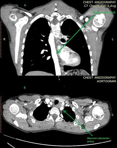 Figure 4 Chest CT showing right aortic arch (A) and aberrant origin left subclavian artery (B).