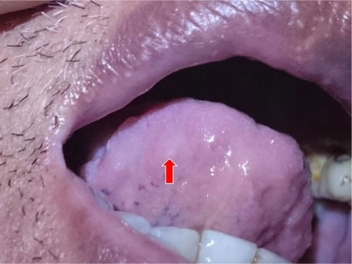 Figure 1 Oral ulcer at the posterior aspect of the tongue (red arrow).