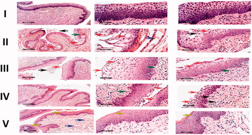 Figure 8. Microscopical histopathological examinations of rats with vaginal candidiasis 7 days after infection stained by Hematoxylin and Eosin. I. Section of negative control rat vagina showing normal morphological features of the vaginal mucosa with almost intact lining epithelium. II. Section of positive control rat vagina showing apoptotic vaginal keratinocytes (red arrow), intraluminal desquamated epithelial cells (black arrow), congestion and dilatation of submucosal blood vessels (blue arrow) as well as subepithelial inflammatory cells infiltrate (green arrow). III. Section of rat vagina treated with the optimized drug-free MLNCs showing the same records as the positive control samples. IV. Section of rat vagina treated with VCZ suspension showing degenerative changes in superficial layers of vaginal keratinocytes (red arrow) with occasional intraluminal desquamated cells (black arrow), subepithelial inflammatory cells infiltrates (green arrow), and minimal records of congested submucosal blood vessels. V. Section of rat vagina treated with the optimized VCZ loaded MLNCs showing normal morphological features of the vaginal mucosa with almost intact lining epithelium (yellow arrow) and nominal congested submucosal blood vessels (blue arrow).