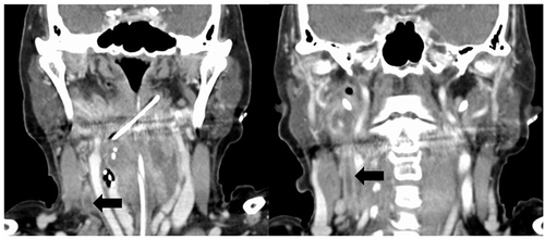Figure 2 Enhanced computed tomography of the neck. Black arrow indicates right internal jugular vein thrombosis.