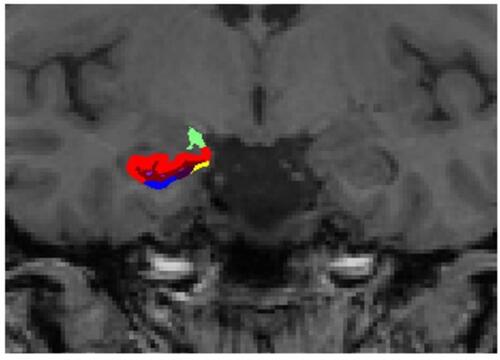 Figure 3 Representative subdivision of the hippocampal subfields. The mask of each region was overlapped on the coronal T1-weighted images. Color classification: parasubiculum = yellow; presubiculum = black; subiculum = blue; Cornu Ammonis (CA)1 = red; CA3 = dark green; CA4 = brown; granule cell layer of dentate gyrus (GC-DG) = sky blue; hippocampus-amygdala-transition-area (HATA) = green; fimbria = purple; molecular layer hippocampus (HP) = dark brown; hippocampal fissure = dark purple; hippocampal tail = gray.