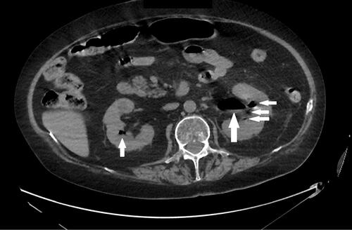 Figure 1 The coronal non-contrast-enhanced computed tomography (CT) scan showing the presence of gas in pelvicalyceal systems of both kidneys (white arrows). CT scans were taken at admission to the hospital.