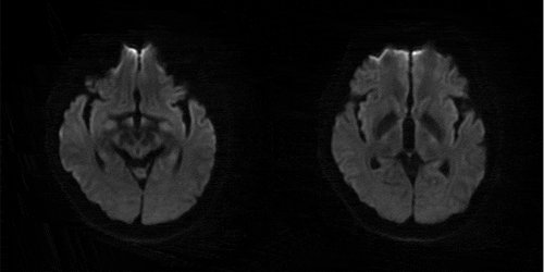 Figure 1. MRI DWI: no abnormal signal intensity in papillary body, thalamus, periaqueduct of the midbrain, cerebellar, brainstem