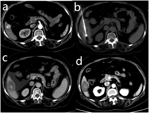 Figure 2. A 65-year-old woman with hepatocellular carcinoma in live segment VI. The patient was treated previously with transcatheter arterial chemoembolization. (a) Contrast-enhanced computed tomography (CT) scan before microwave ablation showed a slightly enhanced lesion with partial lipiodol deposition. The lesion was adjacent to the hepatic flexure of the colon. (b) The electrode needle was inserted into the lesion under CT guidance after the artificial ascites was infused. The lesion was separated from the colon. (c) Contrast-enhanced CT scans obtained immediately after microwave ablation showed complete ablation without enhanced zones in the lesion. (d) No enhancement in the target tumor or peripheral area was observed on the follow-up contrast-enhanced CT 1 month later.