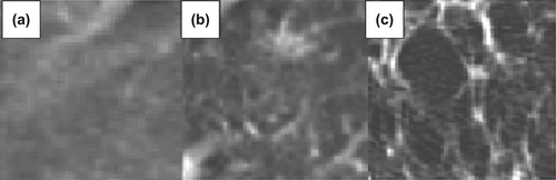 Figure 2. The standard deviation (SD) of CT density was used as a basic texture measure. Three examples from ground glass opacity of patients in this study, showing the differences in texture with the varying SDs: a) 50.1 HU, b) 85.8 HU, c) 123.4 HU.
