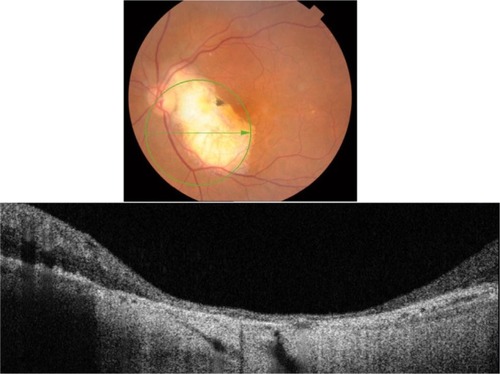 Figure 21 The B-scan line on the fundus photograph (top) has the same width as the B-scan SD-OCT image (bottom) demonstrating the appearance of chorioretinal atrophy.