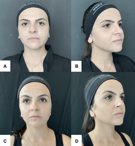 Figure 4 Woman, 36 years old; (A and B) Before procedure; (C and D) 180 days after procedure: discrete slimming of the middle third of the face and marked improvement of jawline 180 days after procedure.