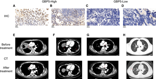 Figure 2 GBP5 expression and CT in SCLC. Immunohistochemical staining of SCLC patients with an anti-GBP5 antibody showed GBP5-High expression (A and B) and GBP5-Low expression (C and D). (Scale bar = 20 μm). Chest CT in SCLC patients with GBP5-High expression (E and F) showed rapid tumor remission after the 6 cycles of combination of EP and ICIs (Durvalumab). Red arrows point to tumor. Chest CT in SCLC patients with GBP5-Low expression (G and H) did not show tumor regression after the 6 cycles of combination of the EP and ICIs (Durvalumab). Red arrows point to tumor.