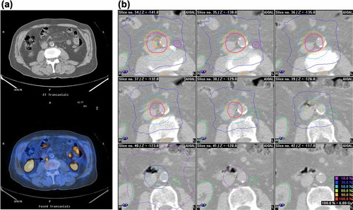 Figure 1. (a) Single nodal paraaortic metastasis (arrow→) detected by 18F-Choline PET-CT from a high-risk prostate cancer patient. (b) Axial planning CT slices showing the dose distribution.