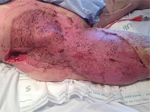 Figure 5 A traumatic degloving wound of the right thigh and buttock.