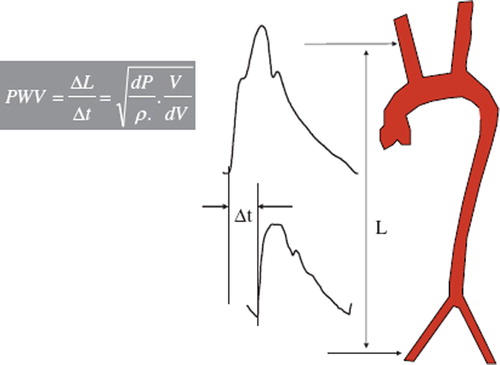 Figure 2. Carotid-femoral PWV is usually measured using the foot-to-foot velocity method, as the ratio of the distance (L) between the measurements sites (common carotid and common femoral arteries) and the transit time (Δt) between the feet of the carotid and femoral pressure waveforms, according to the Bramwell–Hill equation.