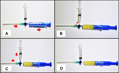 Figure 2 (A) system is set for aspiration after the needle will be in place, red arrows demonstrate the direction of the aspirate from tip of needle towards the aspiration syringe; (B) aspiration is completed and stopcock is rotated clockwise. The red arrow indicates the 90 degree rotation of the stopcock, to block the aspiration syringe and open the injection syringe; (C) treatment solution can be administered without changing needle tip location. The red arrows indicate the direction of injectate flow from medication syringe to the tip of the needle location; (D) double syringe system at the end of the procedure.