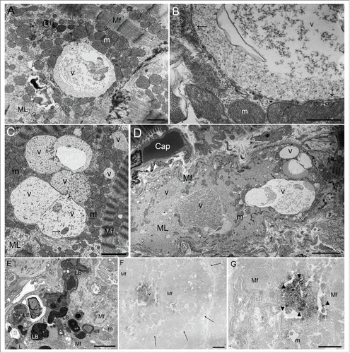 Figure 1. Ultrastructural findings of autophagic vacuoles in cardiomyocytes. (A) An autophagic vacuole (v) in the myofilament (Mf) lysis area (ML); this vacuole contains abundant glycogen granules and ribosomes. Li, lipofuscin; m, mitochondria. Scale bar: 1 μm. (B) An enlarged photomicrograph of panel (A) showing an autophagic vacuole (v) surrounded by a double membrane (arrows). m, mitochondria. Scale bar: 0.5 μm. (C) Fusing autophagic vacuoles (v) contain a mitochondrion (arrow). m, mitochondrial area; Mf, myofilament; ML, myofilament lysis area. Scale bar: 2 μm. (D) There are several different sized autophagic vacuoles (v) apparent in a degenerated cardiomyocyte. Only a few myofilaments (Mf) are seen in the periphery. Cap, capillary; m, mitochondria; ML, myofilament lysis area. Scale bar: 5 μm. (E) Lamellar bodies (LB), irregular electron-dense concentric-layered structures, were found in degenerated cardiomyocytes. L, lipid droplet; m, mitochondria; Mf, myofilament. Scale bar: 2 μm. (F) To assess whether the membrane-bound vacuoles in dilated cardiomyopathy cardiomyocytes have autophagic function, immunohistochemical staining was performed using an antigen retrieval method and the avidin-biotin peroxidase complex technique using a labeled anti-human LC3 antibody.Citation7 Peroxidase depositions in the vacuole (v) indicate immunohistochemical detection of LC3 expression, so these vacuoles were identified as autophagic vacuoles. Since formalin fixation is too weak to maintain the ultrastructure of tissue, and paraffin embedding often destroys most or all of the native LC3 immunopositivity, this combined method is useful. The limited membrane structure was unclear in this photomicrograph because this structure consists of lipoprotein, which may be destroyed at the ultrastructural level by inadequate formalin fixation, or melt during deparaffinization. However, peroxidase deposits can be recognized in the area of the vacuoles owing to the antigen retrieval method. Mf, myofilament. Scale bar: 1 μm. Arrows show the boundary of a cardiomyocyte. (G) An enlarged photomicrograph of panel (F). m, mitochondria; Mf, myofilament; v, vacuole. Scale bar: 1 μm.