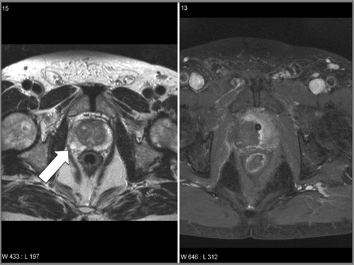 Figure 3. Focal HIFU treatment as primary treatment. The pre-operative MRI on the left shows an enhancing tumour on the left peripheral middle gland proven by targeted biopsies and the post-operative MRI on the right shows the hemi-ablated prostate with no residual enhancement.
