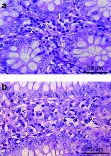 Figure 14 Cell infiltrations A) and edema B) in colon mucosa in IBS patient (1 – plasmocytes, 2 – lymphocytes, 3 – eosinophils, 4 – fibroblasts, hematoxylineosin staining). Bars = 50 μm.