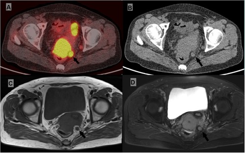 Figure 2 Positron emission tomography/computed tomography (PET/CT, A and B), T1-weighted MR (C) and T2-weighted MR (D) images of a patient with mesorectum metastatic lymph node.