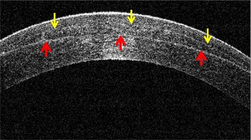 Figure 7 Cap lenticular adhesion with a completely retained lenticule as seen on the anterior segment optical coherence tomography.