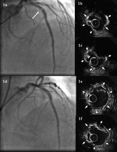Figure 1.  (a) Coronary angiography showing a stenosis with haziness in the proximal left anterior descending artery (LAD) two weeks after sirolimus-eluting stents (SES) implantation. (b) and (c) Intravascular ultrasound imaging of the stented segment at two weeks of follow-up. The maximal plaque prolapse cross sectional area was 2.5 mm2 with a percentage of plaque prolapse burden: 40% of stent area. Stent struts were labeled with arrows. (d) Coronary angiography showing partial resolution of the stenosis with haziness after balloon dilatation. (e) and (f) Intravascular ultrasound imaging of the stented segment after balloon dilatation.
