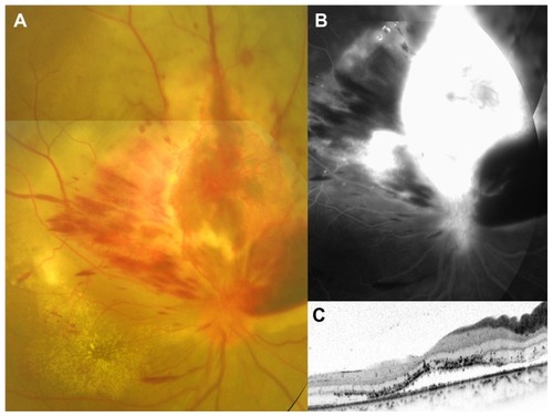 Figure 1 Color fundus photograph, fluorescein angiographic image, and spectral-domain optical coherence tomographic image at the initial visit for a 24-year-old man with aggressive retinal astrocytoma. The best-corrected visual acuity was 0.09. (A) Fundus photograph demonstrates an elevated lesion in the superior aspect of the optic disc accompanied with marked neovascular vessels located on the surface, retinal hemorrhage, and exudative change. Hard exudates are seen in the macula. (B) Late-phase fluorescein angiography reveals marked leakage from the neovascular vessels. (C) Horizontal optical coherence tomographic image through the fovea shows serous retinal detachment.