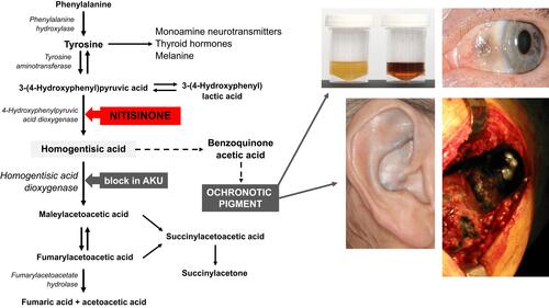 Figure 1 Phenylalanine/tyrosine metabolism in brief and main AKU clinical symptoms.Notes: Metabolic block in alkaptonuria (AKU) affects homogentisic acid dioxygenase (HGD) and causes its accumulation, while nitisinone blocks 4-hydroxyphenylpyruvic acid dioxygenase and impedes formation of HGA. Ochronotic pigment is formed in connective tissue from benzoquinone acetic acid intermediate product. Main AKU clinical symptoms are homogentisic aciduria (urine gets dark upon standing, due to the presence of HGA) and ochronosis (dark pigmentation) of ear, eye, and joints.