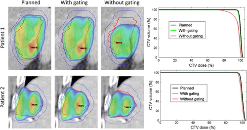 Figure 3. Left: Planned dose distributions in a coronal plane in the center of the CTV (red contour) and PTV (blue), and reconstructed dose distributions in the gated treatments and in the simulated non-gated treatments accumulated over fractions 1–3 for Patients 1 and 2. Dose levels > 95% are shown. Right: Corresponding dose-volume histograms for the CTV.