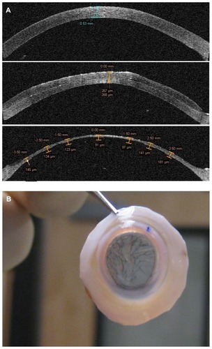 Figure 1 Visante anterior segment optical coherence tomography image (A) showing initial cornea graft thickness (prior to epithelial removal) (top), after a 200 μm head pass (middle), and after the second 110 μm pass (bottom). After the double-passes, the cornea scleral rim shows striae as evidence of the thinness of less than 100 μm (B).