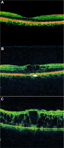 Figure 8 Spectral domain optical coherence tomography (SD-OCT) showing various grades of ELM and ISel band disruption.