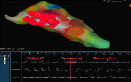 Figure 4 Three-dimension electroanatomical mapping of the left ventricle.
