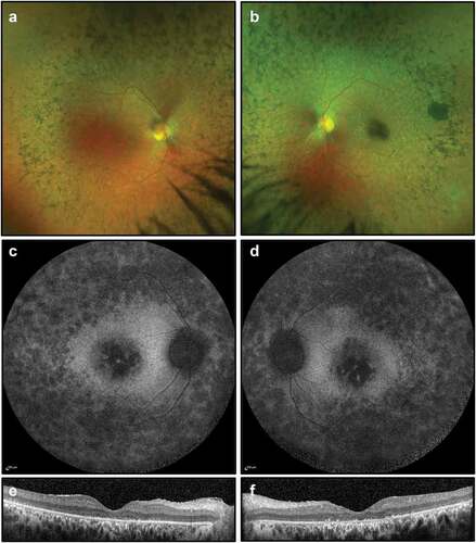 Figure 4. Retinal imaging for Case 2: (a, b) colour photographs of fundi demonstrating widespread peripheral bone spicule pigmentations and attenuated vessels; (c, d) widefield FAF imaging (55 degrees) demonstrating widespread autofluorescence atrophy and macular atrophy with no ring of increased autofluorescence; (e, f) OCT imaging showing extensive photoreceptor loss, outer retinal degeneration, absence of foveal ellipsoid zone and presence of subretinal material, thought to be secondary to the defective phagocytic process by the RPE.