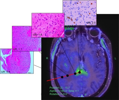 Figure 5 FET PET-guided stereotactic biopsy.