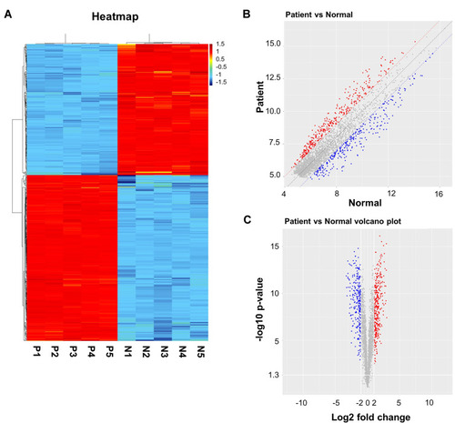 Figure 1 CircRNAs are differentially expressed in IVDD tissues and normal controls. (A) Hierarchical clustering heat map showing the circRNA expression profiles of IVDD tissues (P group) and normal controls (N group) according to P value, which downloaded from GSE67566 dataset. (B) Scatter plot revealed the normalized circRNA expression in patient group and normal group. The y-axis represented the circRNA level in patient group. The x-axis represented the circRNA level in normal group. (C) Volcano plot of DEcircRNAs in GSE67566. The red spots represented high-expressed circRNAs, and the blue spots represented low-expressed circRNAs. P‑value <0.05 (-log10 p-value > 1.3) and |log2 Fold Change| > 2 were set as the threshold.