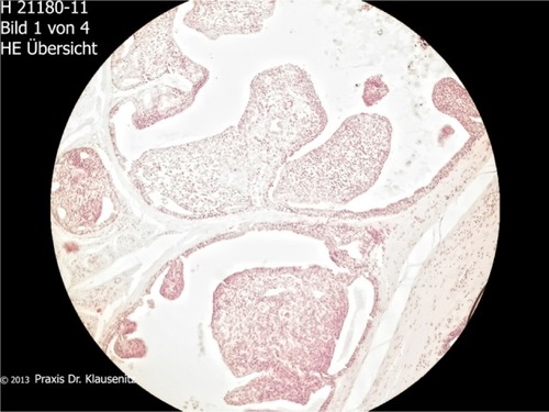 Figure 3 Low-grade papillary eccrine adenocarcinoma with intracystic macropapillary contents.