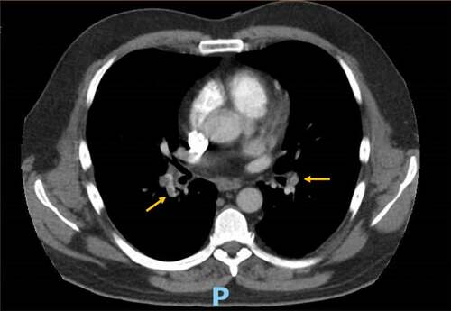 Figure 1. Computer tomography angiography of the chest demonstrating bilateral segmental lower lobe pulmonary embolism