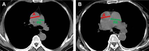 Figure 1 Diameters of the PA and A were determined by CT scan at the PA bifurcation. (A) PA/A ratio < 1; (B) PA/A ratio > 1.
