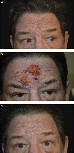 Figure 8 Before (A) and immediately after (B) continuous wave fully ablative carbon dioxide laser treatment, and 2 weeks following (C) treatment for metaphyma (enlargement of sebaceous glands on the forehead).