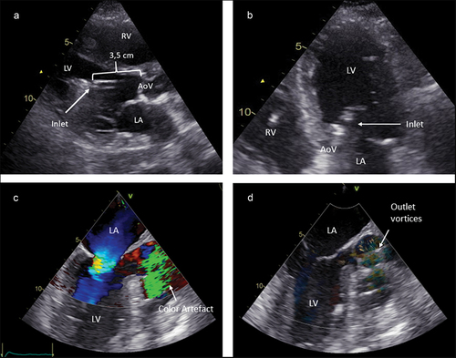 Figure 6. pVAD position examples. A. Transthoracic parasternal long axis view showing a normal position with 3.5 cm insertion depth and free inlet. B. Transthoracic apical 5-chamber view showing the inlet in the left ventricle. C. Transoesophageal aortic valve long axis view, showing the outlet Doppler artifact in the aortic root. D. Blood speckle tracking echocardiography showing the turbulence in the aortic root at the level of the pVAD outlet. AoV = aortic valve. LA = left atrium. LV = Left ventricle. RV = right ventricle.