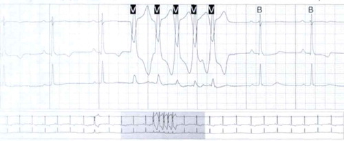 Figure 3. Holter monitor showing non-sustained ventricular tachycardia with left bundle branch block pattern.