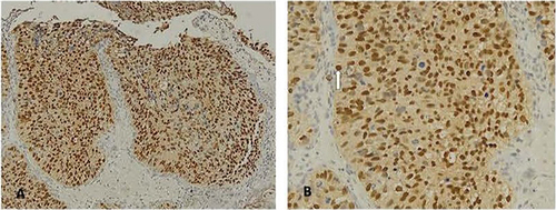 Figure 1 Nuclear androgen receptor (N-AR) and the expression of RA in patients with urothelial bladder carcinoma (A) AR + nuclear magnification 100x; (B). AR + nuclear magnification 200x.