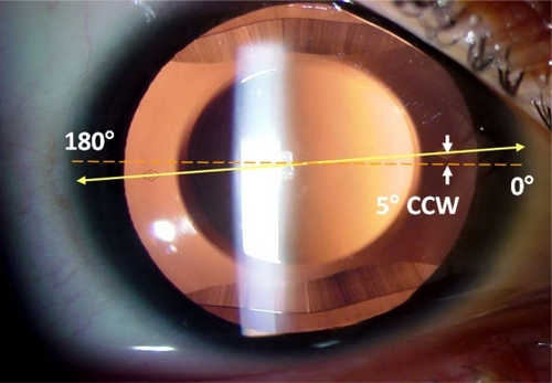 Figure 1 Toric Visian ICLV4 lens. Red dotted line indicates the eye’s horizontal axis. Yellow line indicates lens horizontal axis connecting the two diamond-shaped marks of the toric ICL. The arrows indicate that the surgeon aligned the lens at 5° counterclockwise from the horizontal meridian.