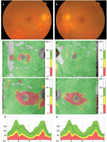 Figure 2 Fundus photographs and results of measurement of the macular GCC and cpRNFL obtained from Case 2.