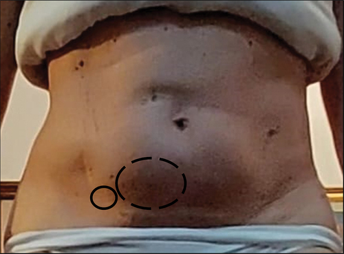Figure 3. Patient’s abdomen at the first physiotherapy consultation. The solid circle indicates the McBurney’s point where the presence of a palpable mass of solid consistency did arise (dashed circle) in the right iliac fossa.