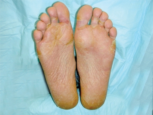 Figure 2 Grade 2 hand-foot syndrome including erythema, desquamation, and skin discoloration. Considered grade 2 because mild discomfort did not interfere with function.