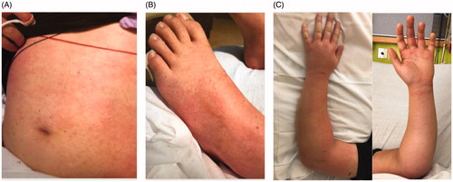 Figure 1. Cutaneous findings on day of presentation. A. Macular rash on trunk. B. Macular rash on lower extremities. C. The left forearm was moderately swollen and focally tender to the proximal ulna at the site of checking injury.