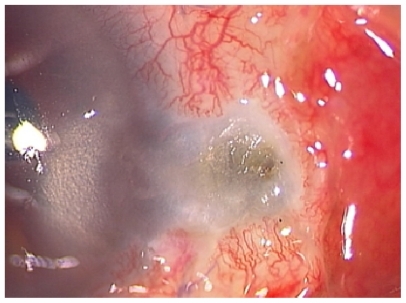 Figure 1 Slit-lamp photograph of surgically induced necrotizing scleritis on postoperative day 29. Although the scleral bed was covered by keratinized conjunctival epithelium, active inflammation and epithelial defect were observed adjacent to the site of thinning.
