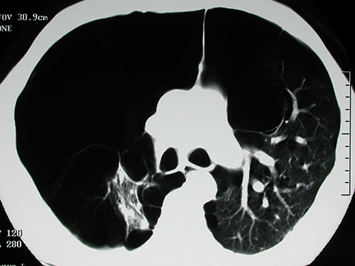 Figure 3 Chest computed tomography from the same person with HIV and COPD demonstrating large, bilateral bullae. This individual eventually underwent bullectomy with dramatic improvement in his respiratory status (Courtesy of Laurence Huang, MD).