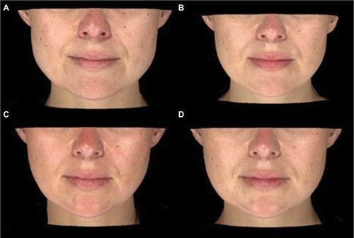 Figure 5 Patient at baseline (A), week 6 (B), week 16 (C), and week 20 (D) after the injection of incobotulinumtoxinA using SIT for the treatment of masseter hypertrophy.