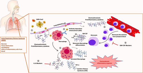 Figure 1 Role of monocyte-macrophage in SARS-CoV-2 pathogenesis: 1) SARS-CoV-2 infection of lung tissue induces release of chemoattractant proinflammatory cytokines by epithelial cells and fibroblasts. 2) Viral antibody-dependent enhancement (ADE) of macrophages could trigger SARS-CoV-2 infection of leucocytes. 3) Chemoattractant gradient induces massive recruitment of inflammatory monocytes from peripheral blood. 4) Monocyte-macrophage activation and differentiation is triggered by GM-CSF and IL-6. 5) An overexuberant activation of macrophages produces the cytokine release syndrome (CRS) responsible for the acute respiratory distress syndrome (ARDS) typical of severe patients. 6) Therapeutical blockade of IL-6 and GM-CSF combination could avoid severe lung immunopathology in COVID-19 patients.