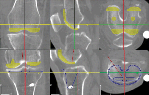 Figure 4. Transferring the CT data to ORTHODOC, the surgeon selected the type and size of component and the polyethylene from the menus and positioned them freely via mouse control with the ORTHODOC software.