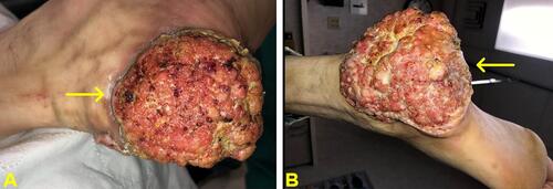 Figure 1 (A and B) Fungating mass of approximately 15×15 cm noted at the left heel appreciated via lateral view (A) and inferior view (B).